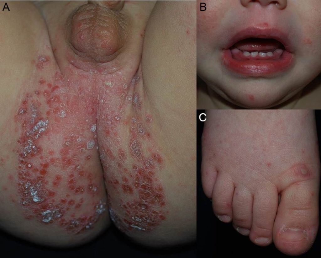 Hand Foot Mouth Disease IRA Childrens Clinic