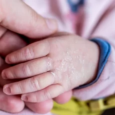 How to Take Care of Dry Skin in Children During Winter?