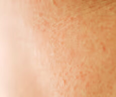 Why Is Your Child’s Skin So Dry and Itchy This Summer?